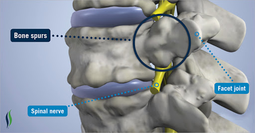 Bone Spurs Treatment And Causes U Get Well Soon