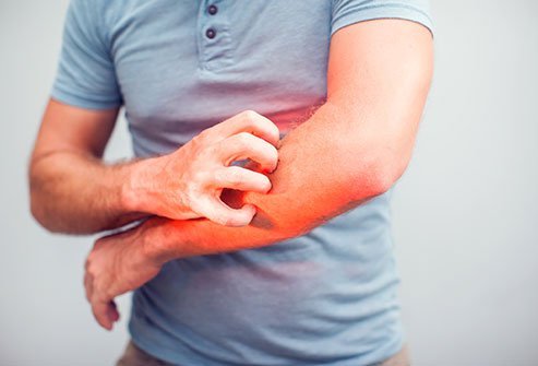 Red man syndrome : Symptoms , Causes and Treatments